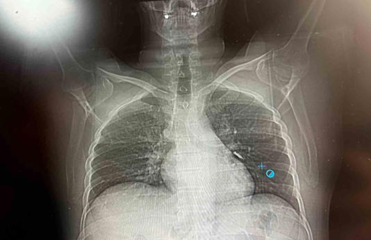Van’da diş tedavisi sırasında implant vidası soluk borusuna kaçan hasta,